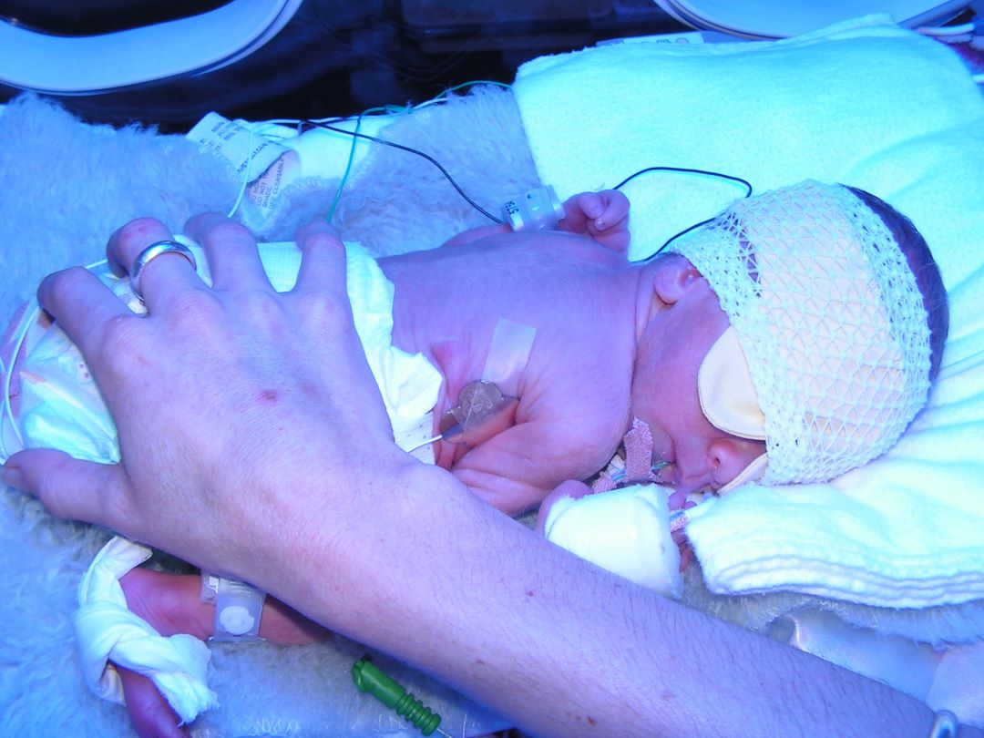 Image of a preterm baby